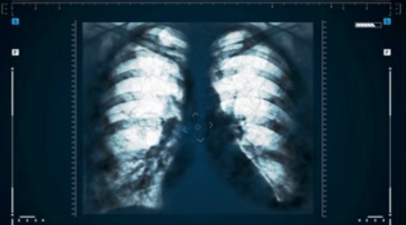 an x-ray photo of lungs